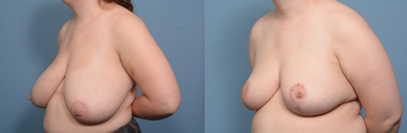 before and after - breast reduction 3 qtr view.png