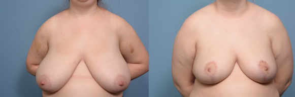 before and after - breast reduction front view.png