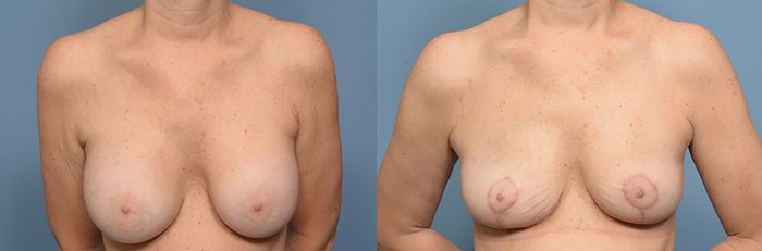breast implant removal 1 before and after front.jpg