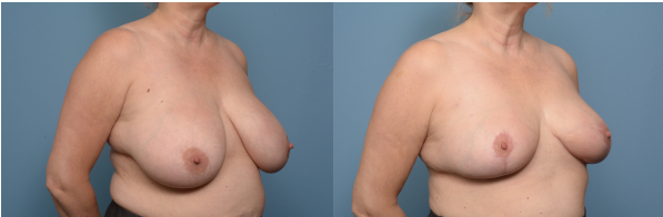 breast reduction 3-4 view right 2022.png