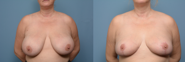 breast reduction front view 2022.png
