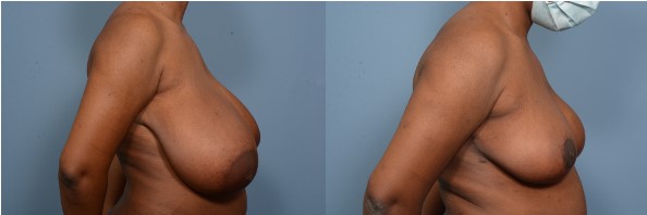 breast reduction side view right.jpg