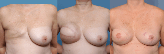 web-4_breast-reconstruction.gif